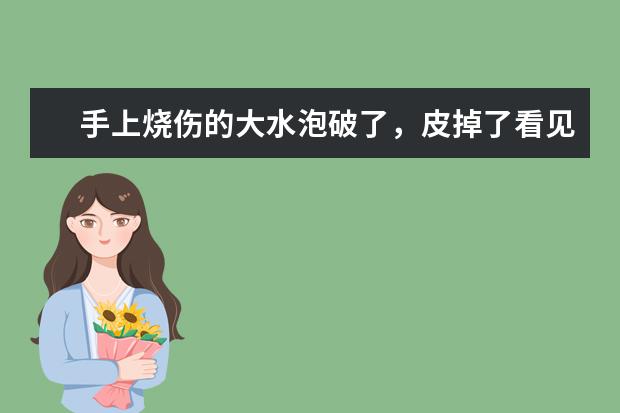 手上烧伤的大水泡破了，皮掉了看见好大一片肉，每天喷外用抗菌离子膜可以吗，还是要配合其他药一块用？